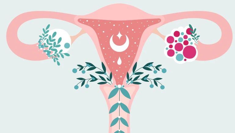 Tratamento do PCOS: 3 mudanças no estilo de vida para curar pcos